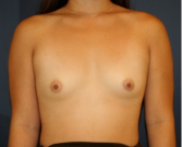 Feel Beautiful - Breast Augmentation 141 - Before Photo